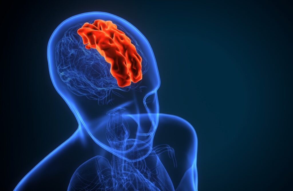 Ilustração em 3D de uma pessoa com o cérebro afetado