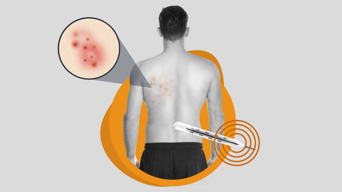 Herpes Zoster: Veja algumas das perguntas mais frequentes sobre o tema.