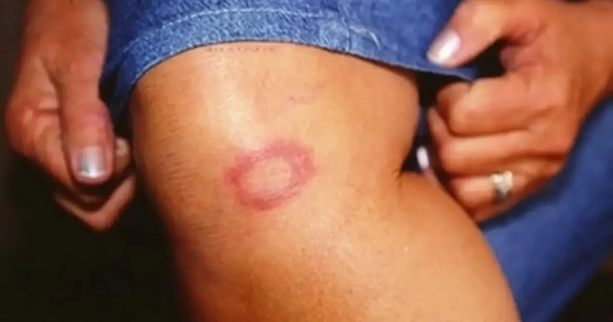 Bahia registrou mais de 1.400 casos de Hanseníase em 2024