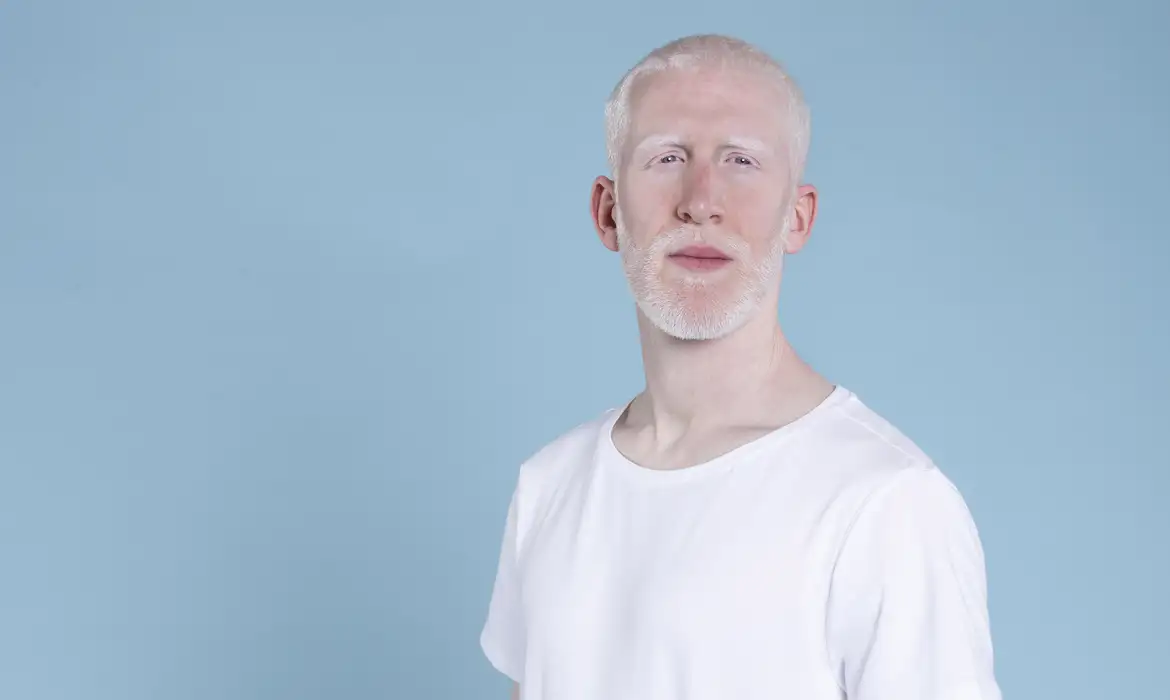 Agora é lei! Política de proteção a pessoas com albinismo já está em vigor