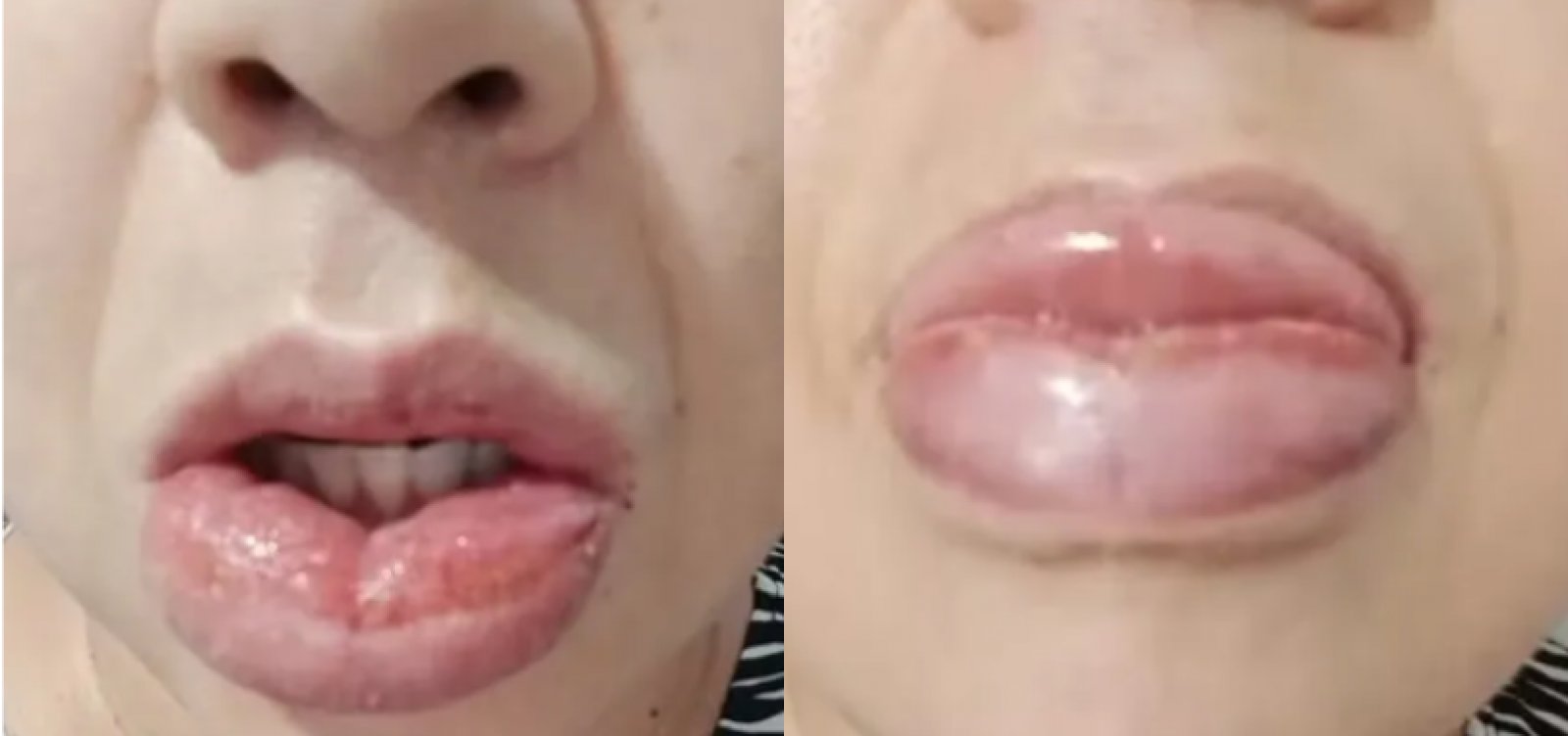 Anvisa registra mais de 1,2 mil casos de reações adversas ao creme dental Colgate Clean Mint