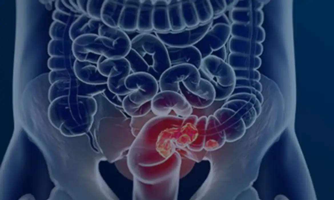 Câncer colorretal: estudo aponta aumento de 36% em mortes até 2040