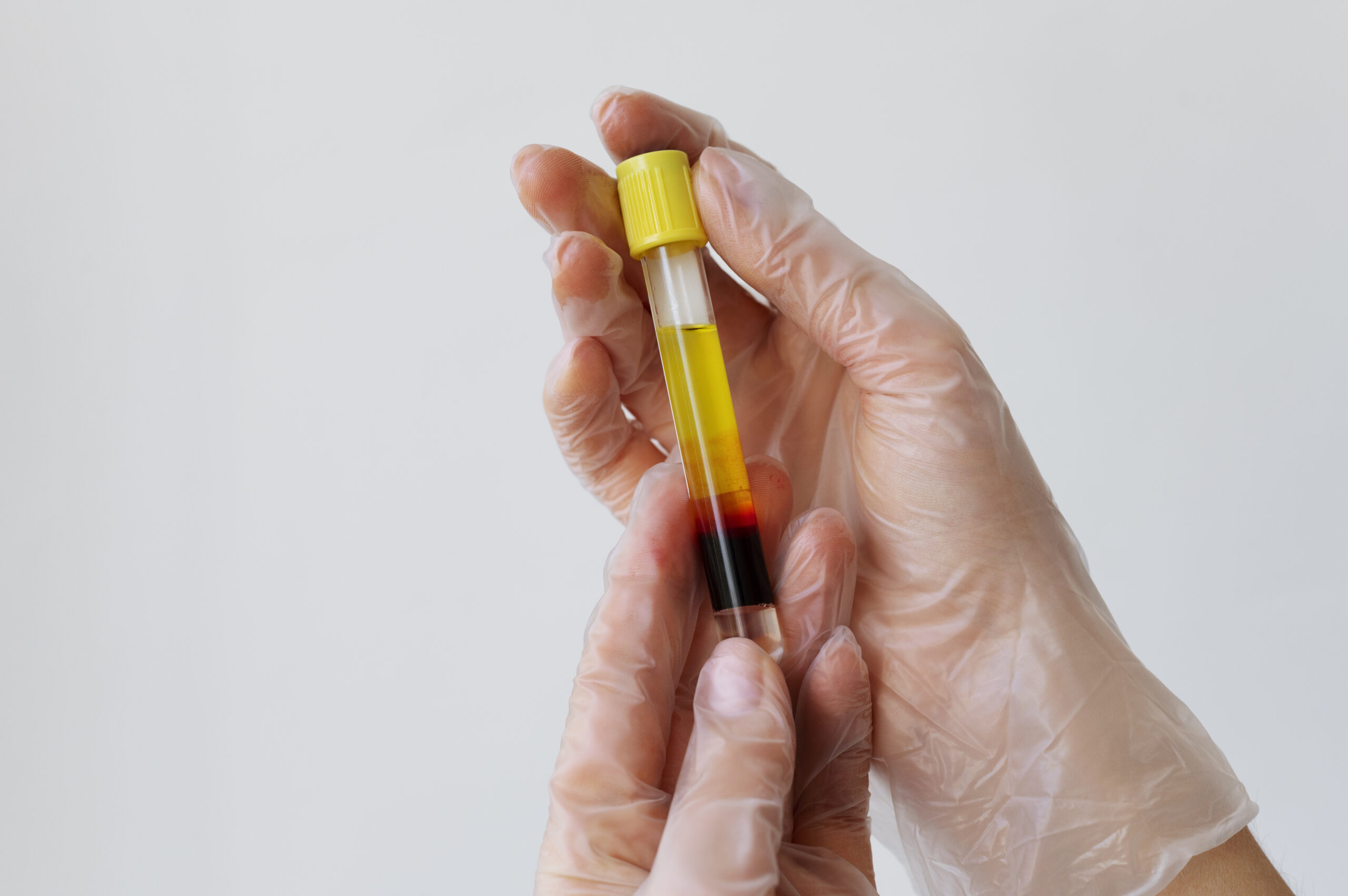 SUS amplia capacidade de armazenar plasma no país